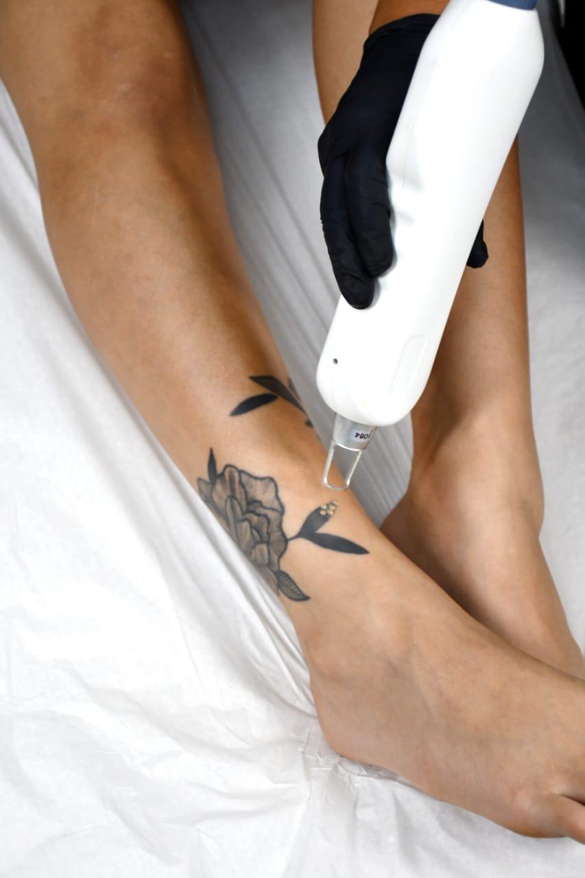 Eliminación de Tatuajes