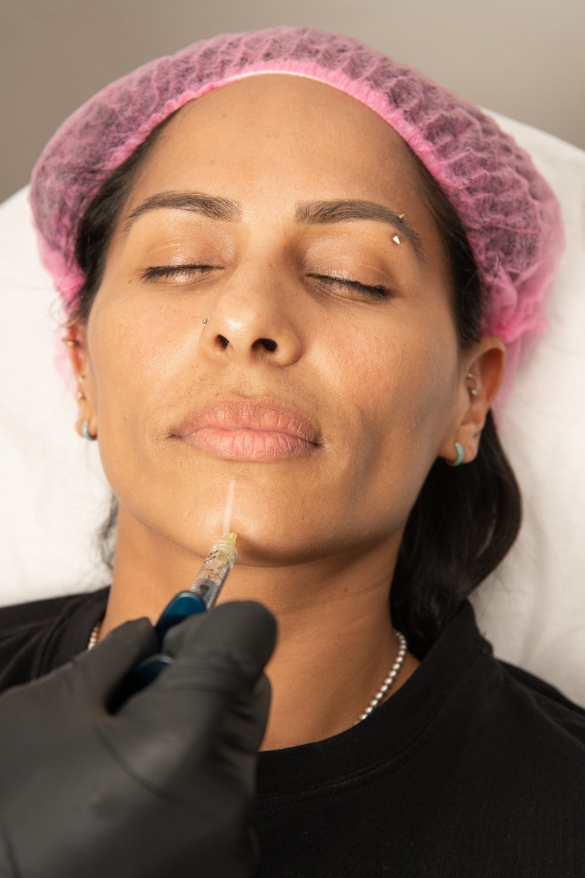 Rellenos de Ácido Hialurónico